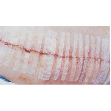 First Aid Skin Closure Surgistrip 6mm X 38mm (6 Strips/pkt) X5