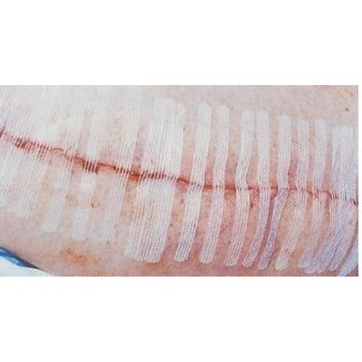 First Aid Skin Closure Surgistrip 6mm X 38mm (6 Strips/pkt)
