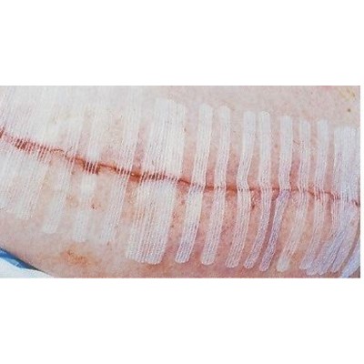 First Aid Skin Closure Surgistrip 6mm X 38mm (6 Strips/pkt) X5